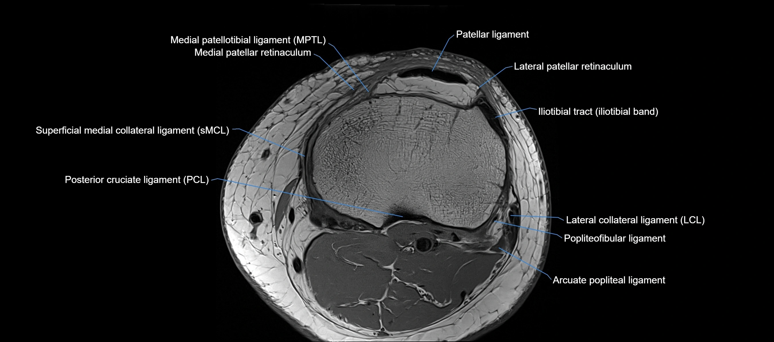 MRI Knee axial  ligaments cross sectional anatomy 3T  radiology  image-img-03001-00035.webp
